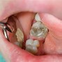 Image result for Rotten Teeth Mouth