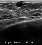 Image result for Sebaceous Cyst On Ultrasound