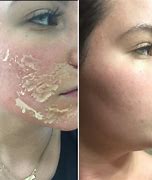 Image result for Chemical Peel During