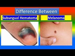 Image result for Basal Cell vs Melanoma