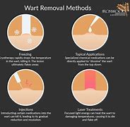 Image result for Wart Removal Diagram