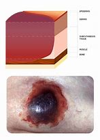 Image result for Comparing Pressure Injury to Apple's