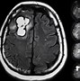 Image result for Cerebellar Meningioma