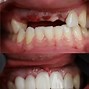 Image result for Tooth Phone Implant