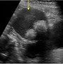 Image result for Dermoid Cyst vs Teratoma Ultrasound