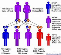 Image result for Heterozygous Sickle Cell