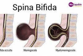 Image result for Spina Bifida Cystica
