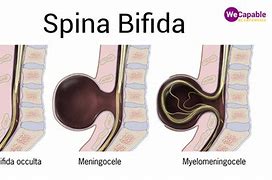 Image result for Mild Spina Bifida Occulta