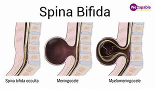 Image result for Spina Bifida Adalah