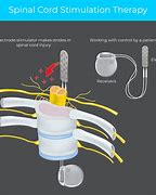 Image result for Spinal Cord Stimulator