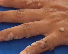 Image result for Verruca Vulgaris Common Warts