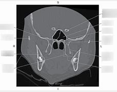 Image result for sphenoid bones cat scans