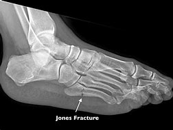 Image result for Jones Fracture Orthobullets