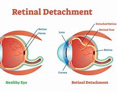 Image result for Retinal Detachment Treatment