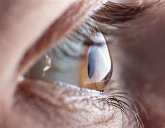 Image result for Contact Lenses for Severe Astigmatism
