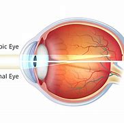 Image result for Myopia vs Normal Eye
