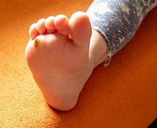 Image result for AAFP Foot Warts