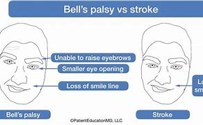 Image result for Bell's Palsy vs Stroke Face