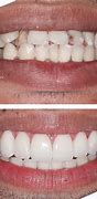 Image result for Difference Between Veneers and Crowns