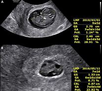 Image result for Gestational Age 9 Weeks