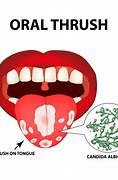 Image result for Oral Thrush Dry Mouth