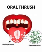 Image result for Oral Thrush Tongue Crack