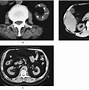 Image result for Analgesic Nephropathy