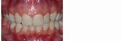 Image result for Tooth Braces Emoji