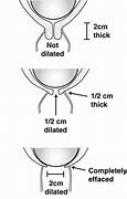 Image result for Dilation Stage