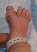 Image result for Newborn Foot Deformity