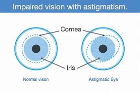 Image result for What Is Astigmatism of the Eye