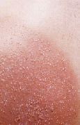 Image result for Sun Poisoning