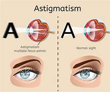 Image result for Astigmatism Camera Lens