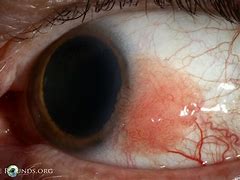 Image result for Post Operated Conjunctival Papilloma