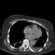 Image result for Ovarian Dermoid Cyst 10Cm