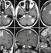 Image result for Meningioma Radiology