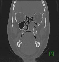 Image result for Inverted Papilloma Radiology