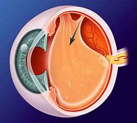 Image result for Eye Floater Vitreous Detachment