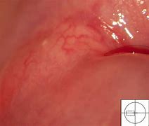 Image result for Cervix Cyst