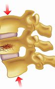 Image result for Compression Fracture Lumbar Spine