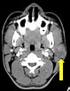 Bildergebnis für Teratome der Glandula parotitis. Größe: 79 x 103. Quelle: radiologycases.my