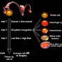 Image result for 4 Cm Ovarian Cyst
