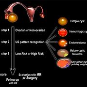 Image result for 5Cm Cyst On Ovary