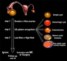 Image result for 7 Cm Ovarian Cyst