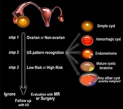 Image result for 4 Cm Ovarian Cyst