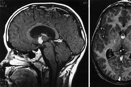 Image result for Choroid Plexus Papilloma 3rd Vrentricle