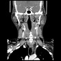 Image result for Warthin's Tumor Parotid Gland