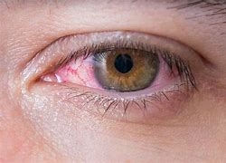 Image result for Infection in Eye