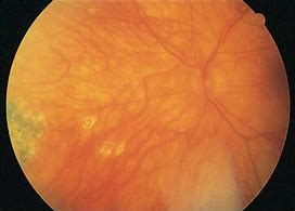 Image result for Syphilis Oct Retina