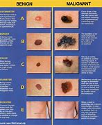 Image result for Skin Cancer Growth